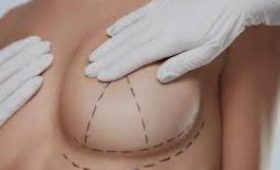 Пластическая хирургия груди: все, что надо знать об операции