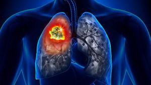 Исследование: одышка и кашель являются первым симптомом рака легких