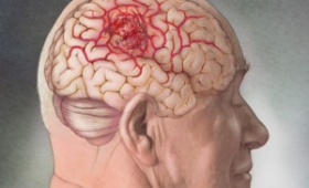 Симптомы рака мозга: нарушение зрения и другие сигналы опухоли
