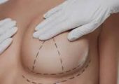 Пластическая хирургия груди: все, что надо знать об операции