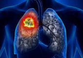 Исследование: одышка и кашель являются первым симптомом рака легких