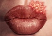 Ученые нашли эффективный способ избавиться от герпеса