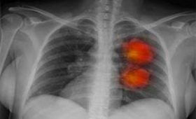 Симптомы рака легких: семь основных предупреждающих сигналов опухо