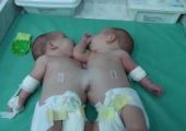 В США успешно разделили сиамских близнецов