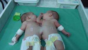 В США успешно разделили сиамских близнецов