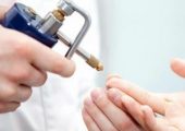 Криодеструкция – востребованная процедура для удаления папиллом и бородавок