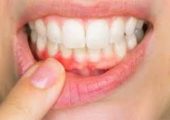 Воспаление десен может привести к болезням сердца и усугубить течение COVID-19